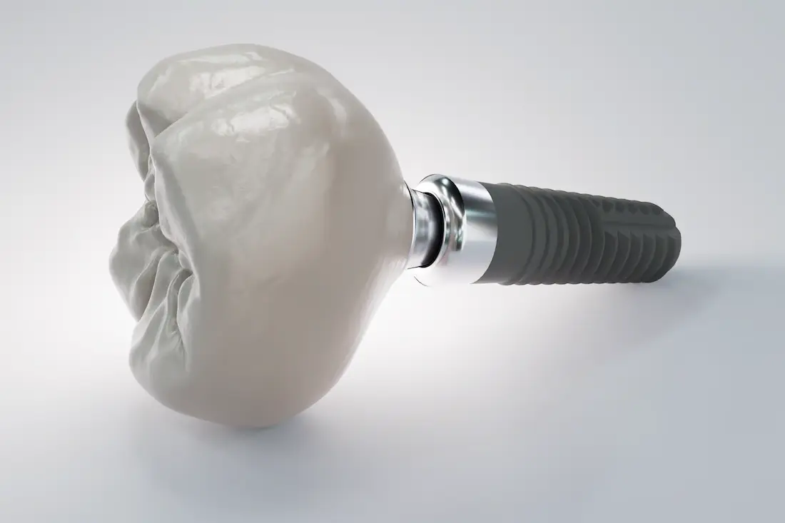 dental-implant