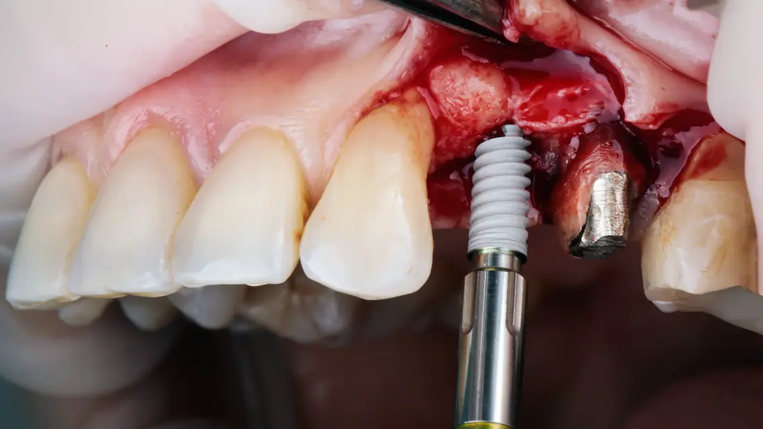 after-dental-implant-surgery