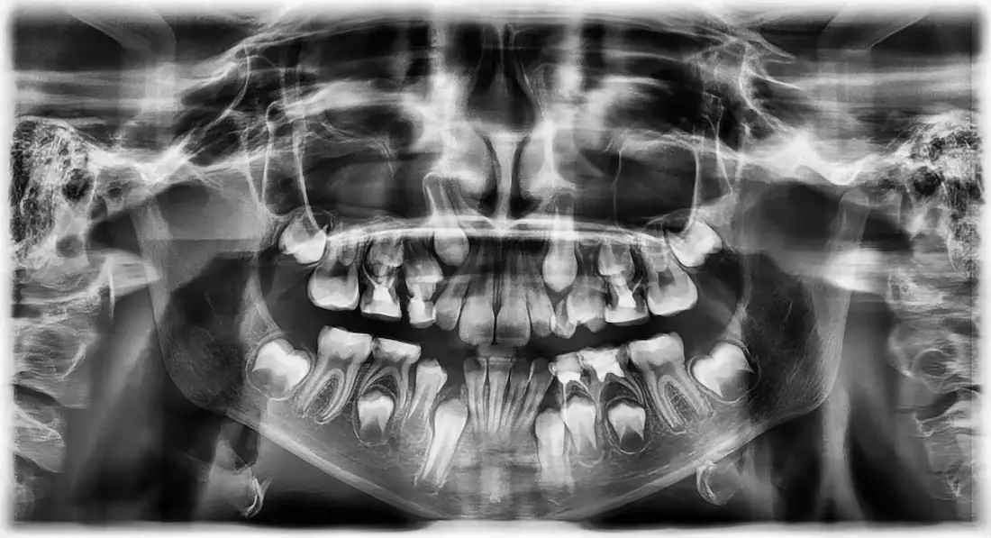 panoramic-x-rays