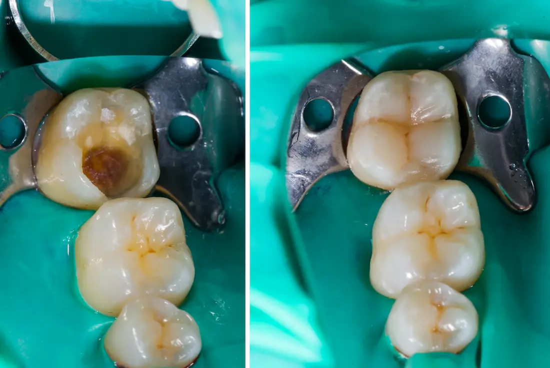 composite-fillings